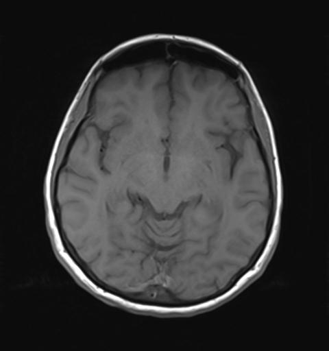 File:Autoimmune limbic encephalitis (Radiopaedia 30363-31005 Axial T1 15).jpg