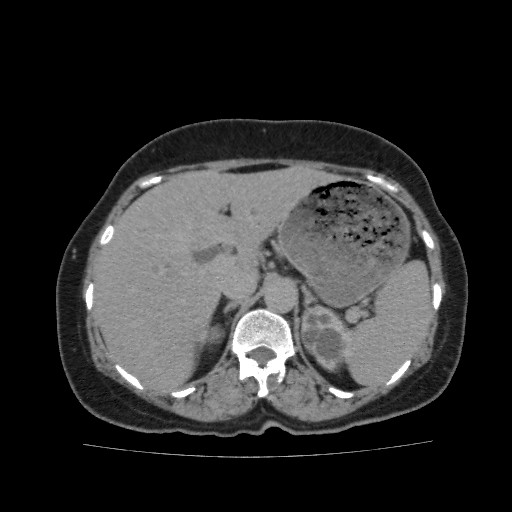 File:Autosomal dominant polycystic kidney disease (Radiopaedia 38189-40194 Axial C+ delayed 11).jpg