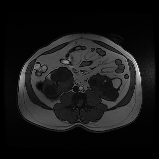Autosomal dominant polycystic kidney disease (Radiopaedia 50259-55611 Axial 2D Dual Echo 59).jpg