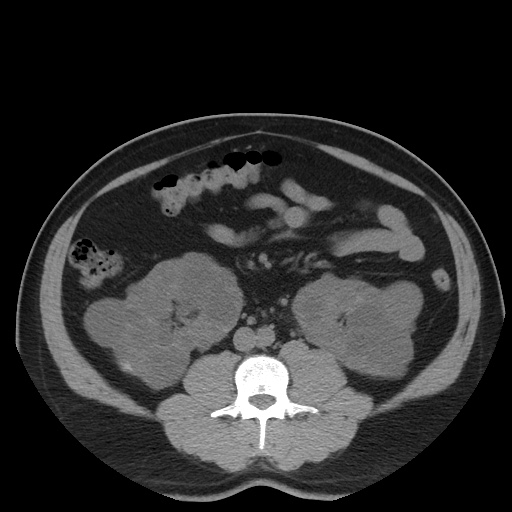 Autosomal dominant polycystic kidney disease (Radiopaedia 50259-55612 Axial non-contrast 46).jpg