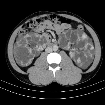 Autosomal dominant polycystic kidney disease (Radiopaedia 66349-75582 B 50).jpg