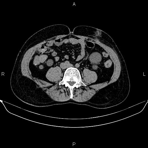 Autosomal dominant polycystic kidney disease (Radiopaedia 87830-104287 Axial non-contrast 35).jpg