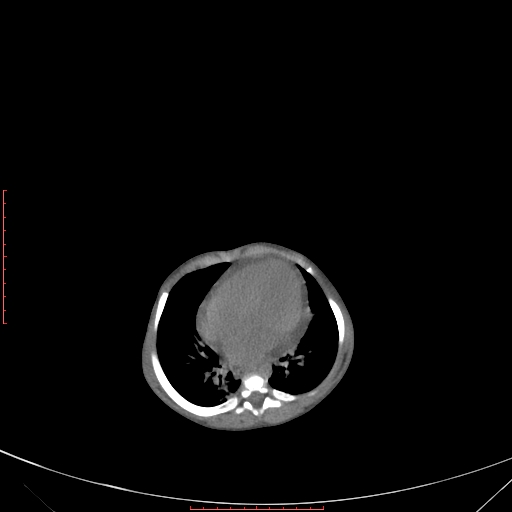Autosomal recessive polycystic kidney disease associated with Caroli disease (Radiopaedia 61932-69984 Axial non-contrast 77).jpg