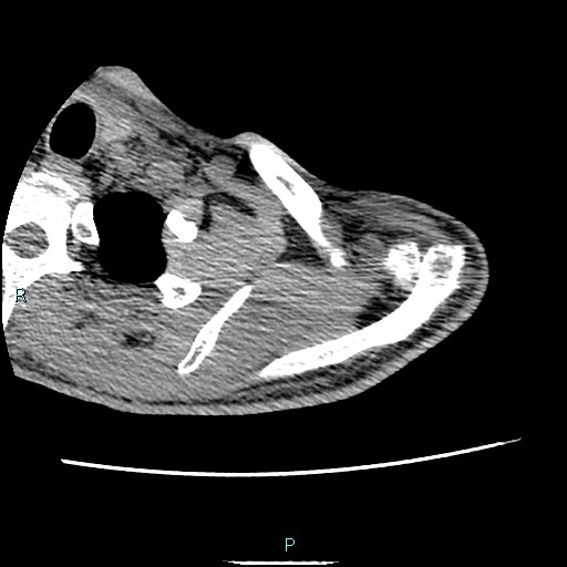 Avascular necrosis after fracture dislocations of the proximal humerus (Radiopaedia 88078-104653 D 17).jpg