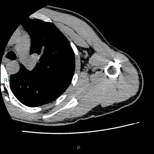 File:Avascular necrosis after fracture dislocations of the proximal humerus (Radiopaedia 88078-104655 D 75).jpg