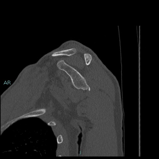 Avascular necrosis after fracture dislocations of the proximal humerus (Radiopaedia 88078-104655 Sagittal bone window 35).jpg