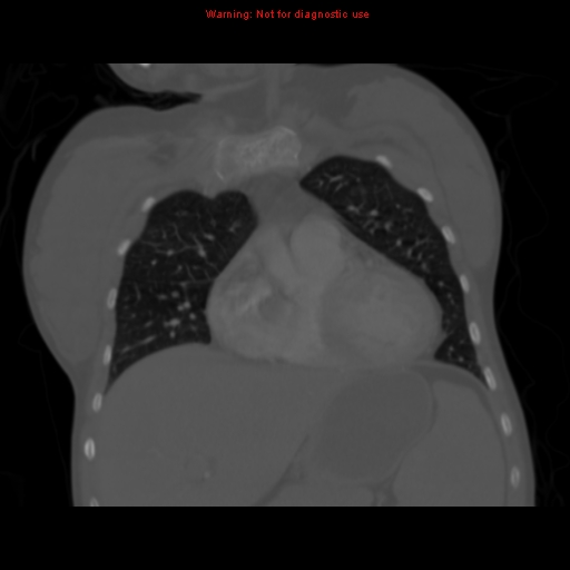 Avascular necrosis in sickle cell disease (Radiopaedia 17448-17152 Coronal bone window 38).jpg