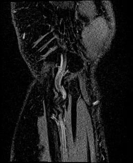 Avascular necrosis of the capitate (Radiopaedia 88317-104948 Coronal T1 vibe 86).jpg