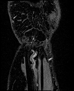 Avascular necrosis of the capitate (Radiopaedia 88317-104948 Coronal T1 vibe 89).jpg