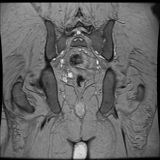 Avascular necrosis of the hip (Radiopaedia 61503-69465 F 77).jpg