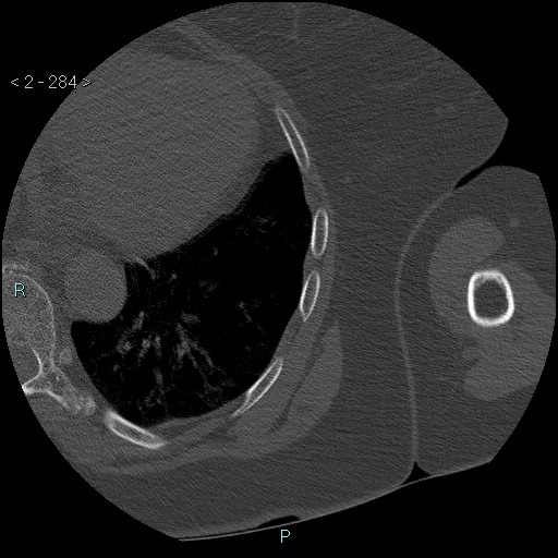 Avascular necrosis of the shoulder - Cruess stage I (Radiopaedia 77674-89887 Axial bone window 71).jpg