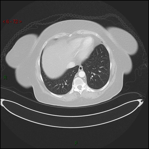 File:Azygos fissure and lobe (Radiopaedia 47620-52278 Axial lung window 72).jpg
