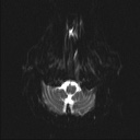 Balo concentric sclerosis (Radiopaedia 50458-55940 Axial DWI 20).jpg
