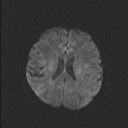 File:Balo concentric sclerosis (Radiopaedia 50458-55940 Axial DWI 55).jpg