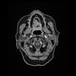 Balo concentric sclerosis (Radiopaedia 53875-59982 Axial LAVA C+ 20).jpg