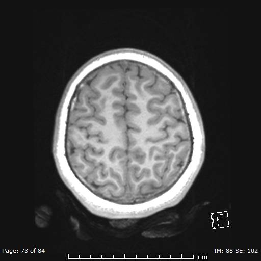 Balo concentric sclerosis (Radiopaedia 61637-69636 Axial T1 73).jpg