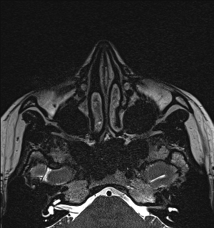 File:Basal cell carcinoma - nasal region (Radiopaedia 70292-80365 Axial Gradient Echo 41).jpg