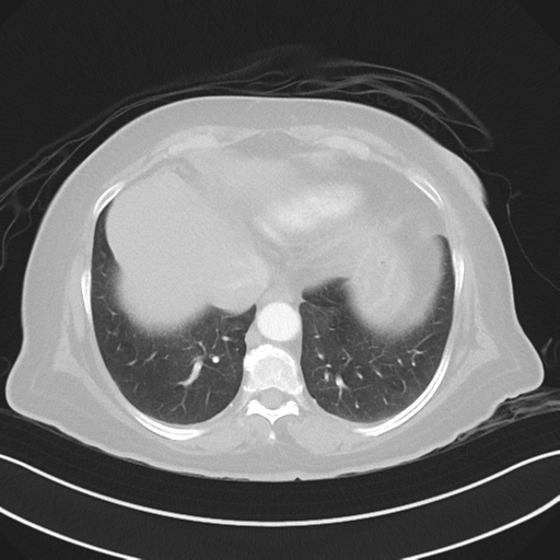 Basal ganglia metastasis (Radiopaedia 78928-91832 B 37).png