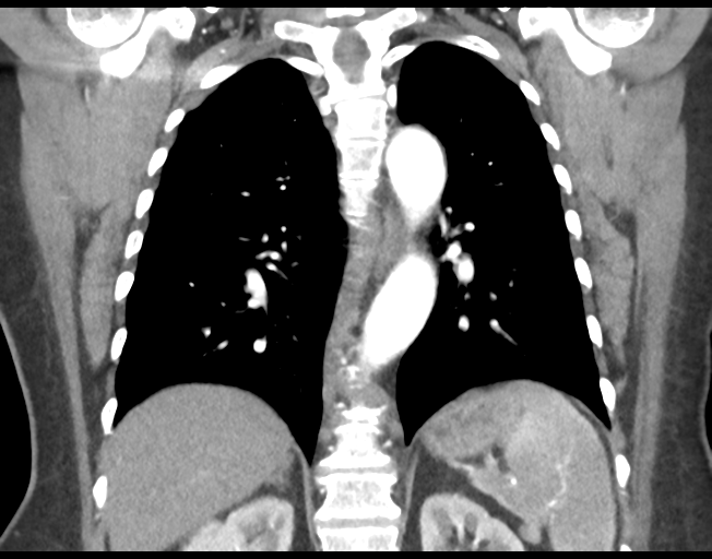 Basal ganglia metastasis (Radiopaedia 78928-91832 C 35).png