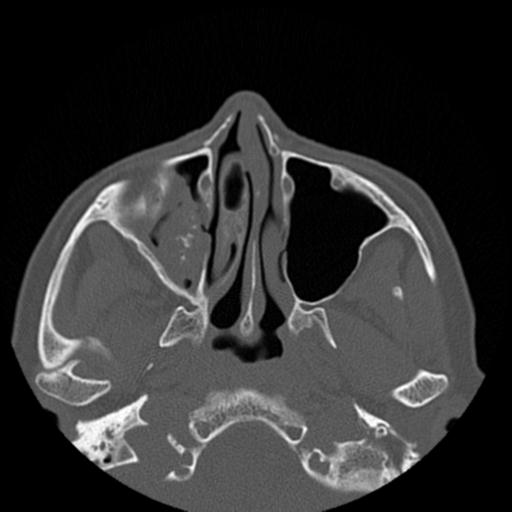 File:Base of skull chondrosarcoma (Radiopaedia 30410-31071 Axial bone window 16).jpg
