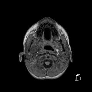 Base of skull rhabdomyosarcoma (Radiopaedia 32196-33142 Axial T1 1).jpg