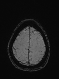 File:Basilar artery perforator aneurysm (Radiopaedia 82455-97733 Axial SWI 53).jpg