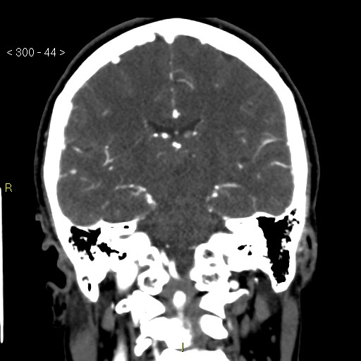 Basilar artery thrombosis (Radiopaedia 16260-15944 B 35).jpg