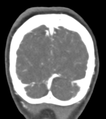 Basilar tip aneurysm with coiling (Radiopaedia 53912-60086 B 143).jpg