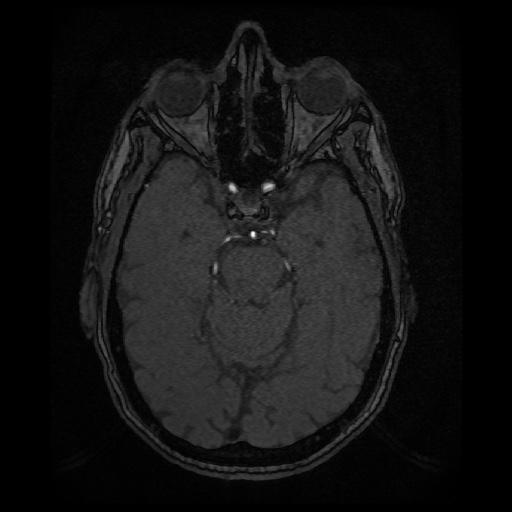 Basilar top and left middle cerebral artery aneurysm (Radiopaedia 61965-70031 Axial MRA 56).jpg