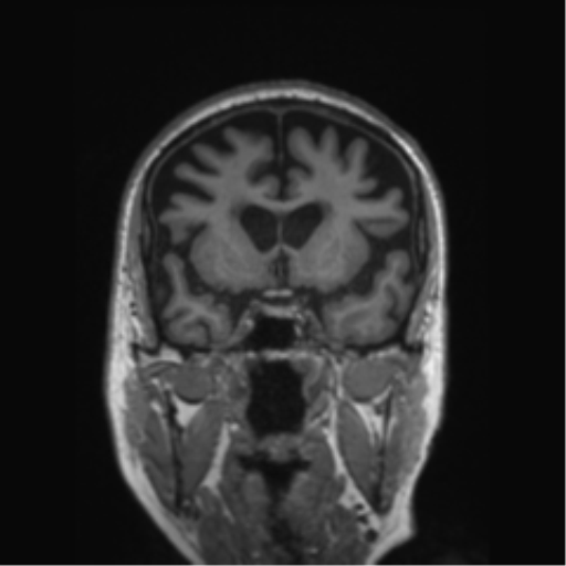 Behavioral variant frontotemporal dementia and late onset schizophrenia (Radiopaedia 52197-58083 Coronal T1 60).png