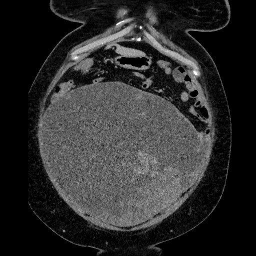 Benign leiomyoma with hydropic features (Radiopaedia 89250-106130 B 37).jpg