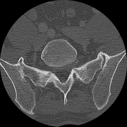 Benign post-traumatic pseudopneumoperitoneum (Radiopaedia 71199-81495 Axial bone window 282).jpg