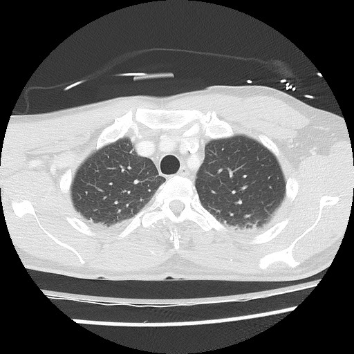 Benign post-traumatic pseudopneumoperitoneum (Radiopaedia 71199-81495 Axial lung window 22).jpg