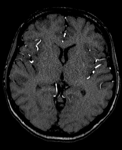 Berry aneurysm of the terminal internal carotid artery (Radiopaedia 88286-104918 Axial TOF 126).jpg