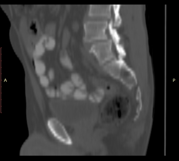 Bertolotti syndrome (Radiopaedia 58974-66235 Sagittal bone window 32).jpg