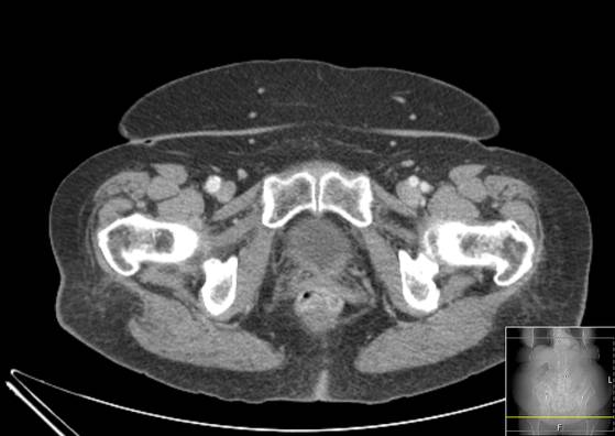 Bicameral celiacomesenteric aneurysm (Radiopaedia 55766-62327 A 73).jpg