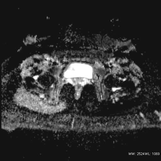 File:Bicornuate uterus- on MRI (Radiopaedia 49206-54297 Axial ADC 19).jpg