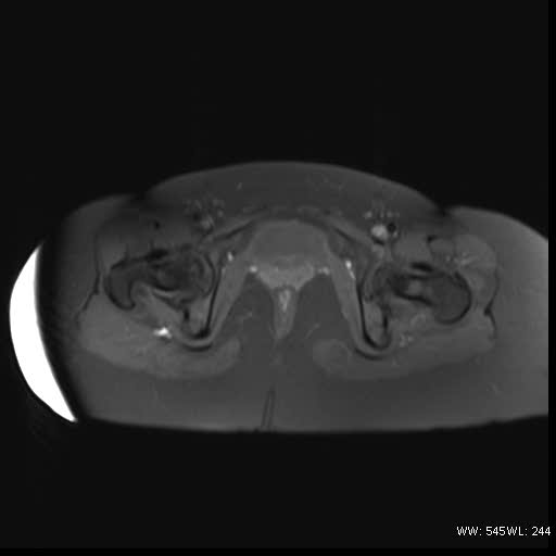 File:Bicornuate uterus- on MRI (Radiopaedia 49206-54297 Axial T1 fat sat 17).jpg