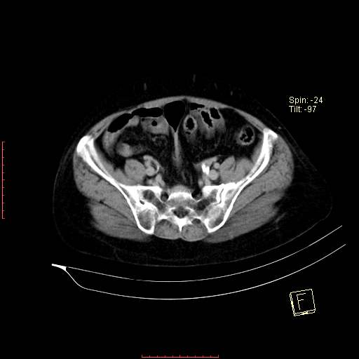 File:Bifid ureter (Radiopaedia 47604-52253 Axial C+ delayed 21).jpg