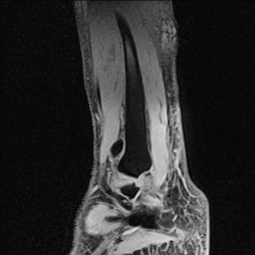 File:Bilateral Achilles tendon complete tear (Radiopaedia 81344-95051 Sagittal WE - Right 28).jpg