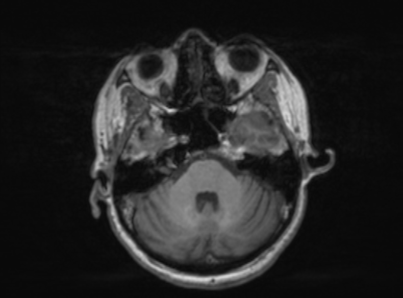 Bilateral PCA territory infarction - different ages (Radiopaedia 46200-51784 Axial T1 300).jpg