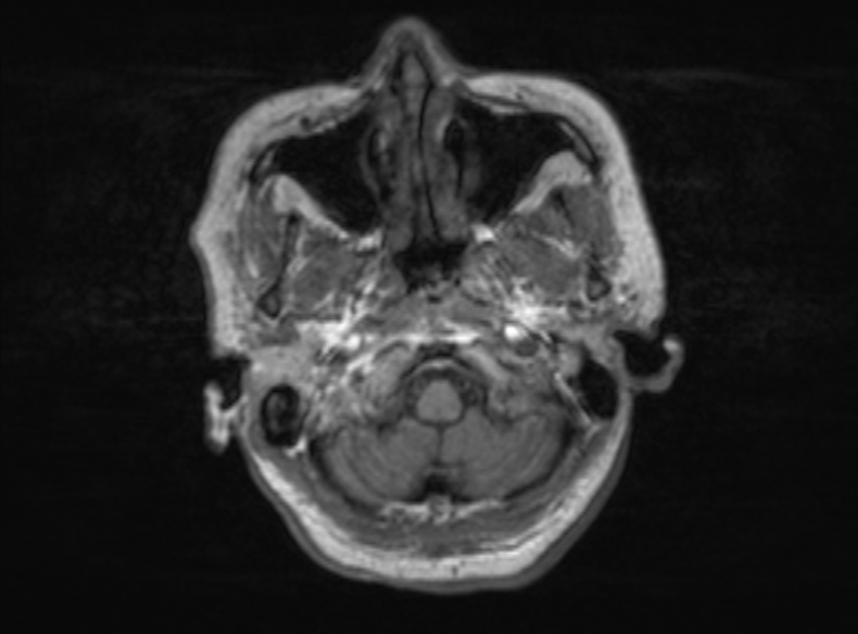 Bilateral PCA territory infarction - different ages (Radiopaedia 46200-51784 Axial T1 342).jpg