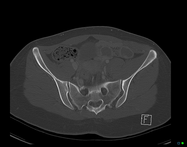 File:Bilateral acetabular fractures (Radiopaedia 79272-92308 Axial bone window 22).jpg