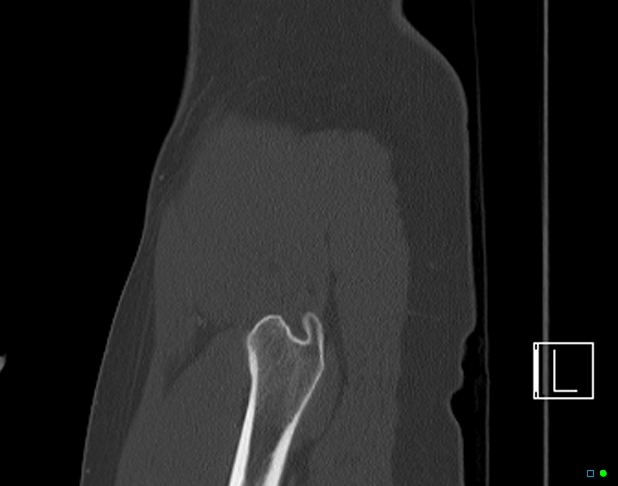 Bilateral acetabular fractures (Radiopaedia 79272-92308 Sagittal bone window 7).jpg