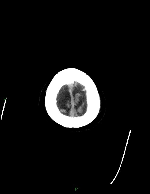 Bilateral acute middle cerebral artery territory infarcts (Radiopaedia 77319-89401 Axial non-contrast 88).jpg