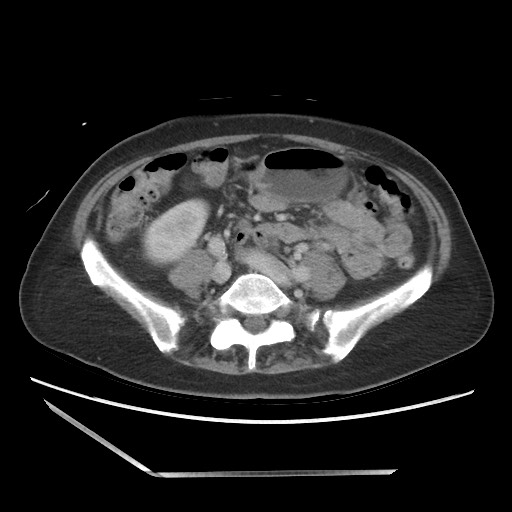 Bilateral adrenal granulocytic sarcomas (chloromas) (Radiopaedia 78375-91007 A 75).jpg