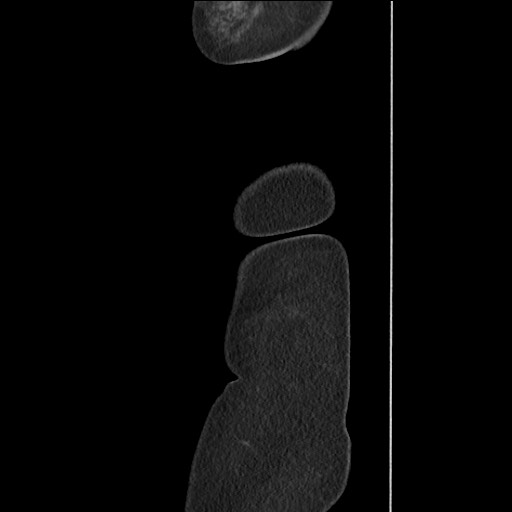 Bilateral adrenal granulocytic sarcomas (chloromas) (Radiopaedia 78375-91007 C 136).jpg