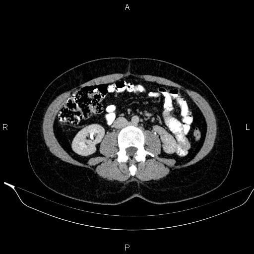 Bilateral adrenal myelolipoma (Radiopaedia 63058-71535 Axial C+ delayed 73).jpg