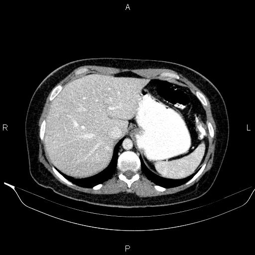 File:Bilateral adrenal myelolipoma (Radiopaedia 63058-71535 B 30).jpg