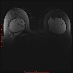 File:Bilateral breast implant rupture (Radiopaedia 24761-25027 PASTA Si 12).jpg